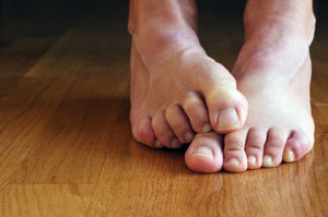 Massapequa Podiatrist | Massapequa Toe Deformities | NY | David G Robbins, DPM |